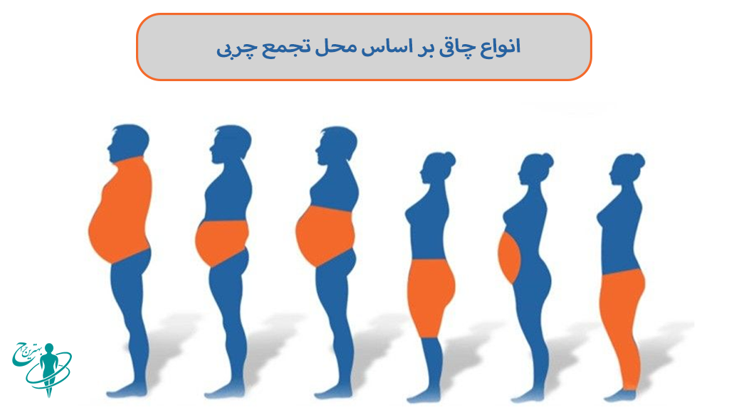 انواع چاقی بر اساس محل تجمع چربی