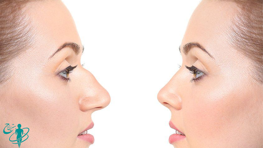 بهترین سن جراحی بینی