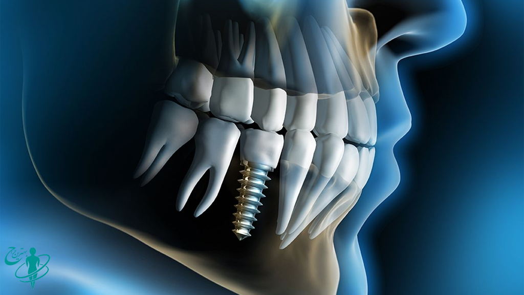 ایمپلنت دندان چیست؟