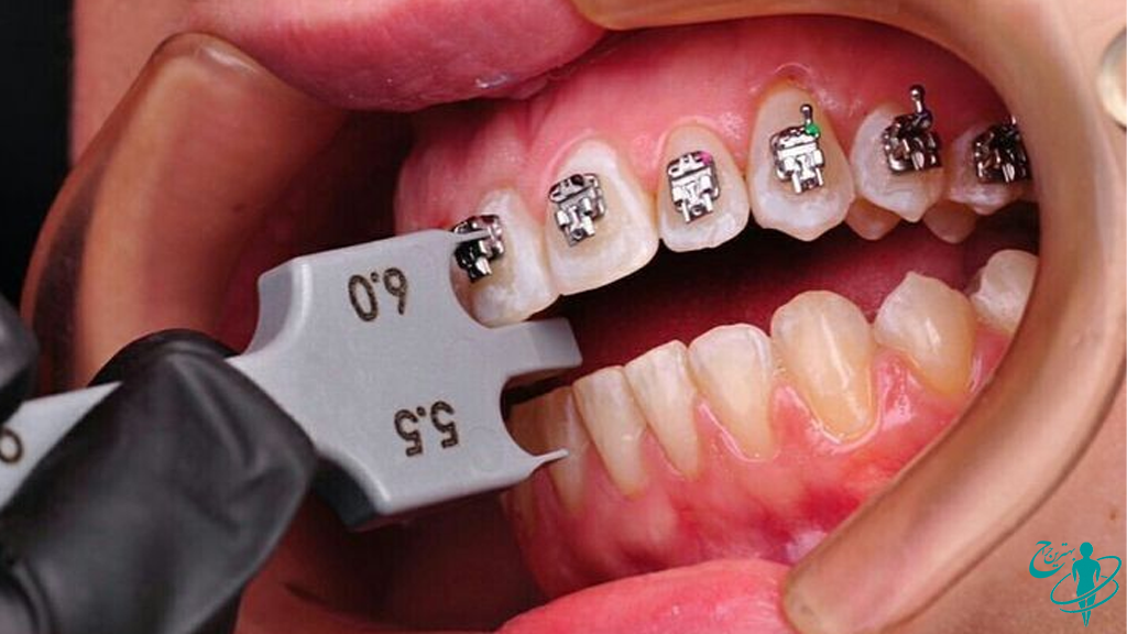 ارتودنسی دندان چیست؟ راهنمای جامع درمان، انواع، مراحل و هزینه ارتودنسی